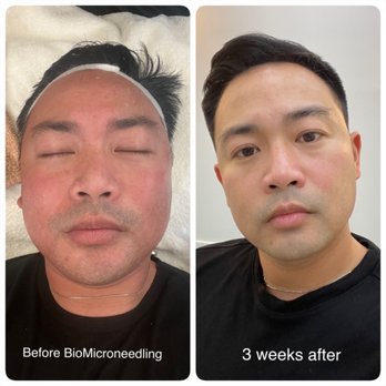 FOUR J AESTHETICS - Before and after BioMicroneedling - Estheticians Near Me - Monterey, California FOUR J AESTHETICS - Before and after BioMicroneedling - Estheticians Near Me - Monterey, California