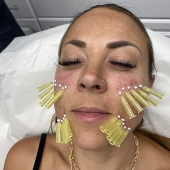 Bombshell Aesthetics - During the threads - Medical Spas Near Me - Hayward, California Bombshell Aesthetics - During the threads - Medical Spas Near Me - Hayward, California
