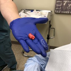 Omni Dermatology - This is the pilomatricoma cyst Dr Racette removed from my son's cheek.