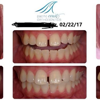 Pacific Coast Orthodontics - First set of pics - Orthodontists Near Me - San Ramon, California Pacific Coast Orthodontics - First set of pics - Orthodontists Near Me - San Ramon, California