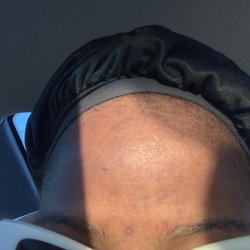 Energy Esthetics - After Month 4 in acne facial