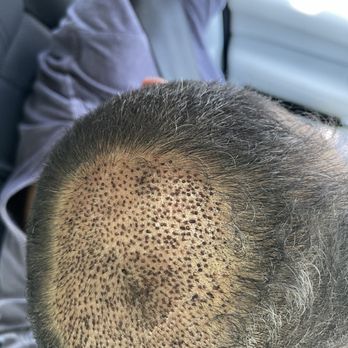 Neopel - One week after - Hair Loss Centers Near Me - Tijuana, BCN