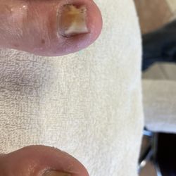 Amy's Nails - Chemo toe damage, I needed extra help!