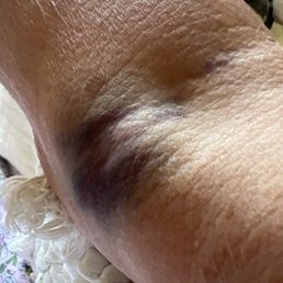 Bruised and lumpy