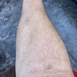 Renton Family Medicine - Shows the bruise on my forearm where they stuck my arm, also shows the point at my elbow where the front desk person stuck my arm.
