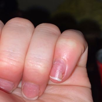 Erika's Spa Beauty Salon - This is how my finger was a WEEK after she ruined my nail - Hair Salons Near Me - Newhall, California Erika's Spa Beauty Salon - This is how my finger was a WEEK after she ruined my nail - Hair Salons Near Me - Newhall, California