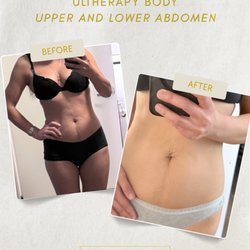 Lumina Med Spa - Before and After: Ultherapy PRIME for skin tightening in the upper and lower abdomen
