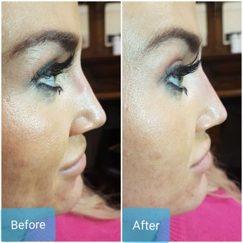 YouGlo - Non-surgical nose hump correction using dermal fillers - Skin Care Near Me - London, XGL YouGlo - Non-surgical nose hump correction using dermal fillers - Skin Care Near Me - London, XGL