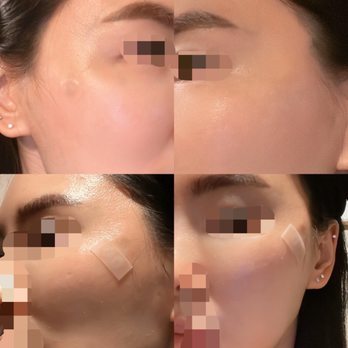 Arc Beauty Lab - It a great result after 5days of threads. I am very satisfied that I feel it makes younger face very naturally. - Medical Spas Near Me - Los Angeles, California