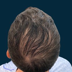 National Center for Plastic Surgery - PRP Hair Restoration After
