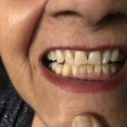 Uptown Dentistry - Before the Veneers