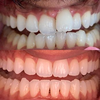 Urbn Dental - Witness the magic of Invisalign, and start your journey to a flawless smile today. Our Orthodontic patient was super happy & we are too! - Cosmetic Dentists Near Me - Houston, Texas Urbn Dental - Witness the magic of Invisalign, and start your journey to a flawless smile today. Our Orthodontic patient was super happy & we are too! - Cosmetic Dentists Near Me - Houston, Texas
