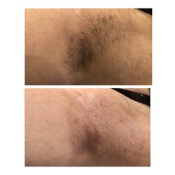 Pretty Kitty Beauty Bar - Before and after underarm was.