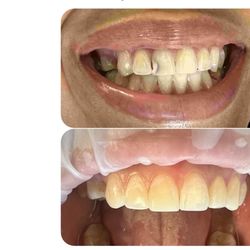 Smile Designers of Las Vegas - Before and After Dr. Barba and Erin's magic touch