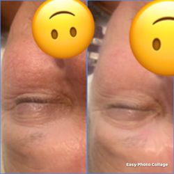 Noor  Spa - After 1 oxygeneo facial! This is a 3 in 1 super facial! It exfoliates, oxygenates and infuses active ingredients into the skin.
