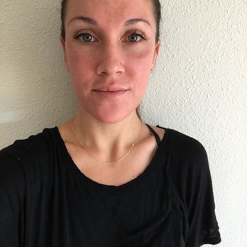 Rachael Ostrea, LE - The next day. A lot of redness and tenderness but no peeling - Permanent Makeup Near Me - Marina del Rey, California Rachael Ostrea, LE - The next day. A lot of redness and tenderness but no peeling - Permanent Makeup Near Me - Marina del Rey, California