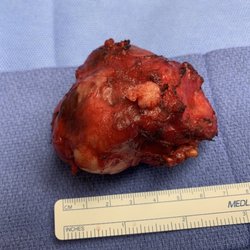 Capo & De Blasi MD - Tumor that was removed from my head by dr Capo and dr DeBLASI. Both EXCELLENT DOCTORS! Successful surgery. God bless them and their staff.