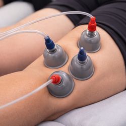Nottinghill Family Wellness Centre - Cupping therapy for muscle tension, pain relief & recovery in Oakville. Improve circulation and mobility naturally.