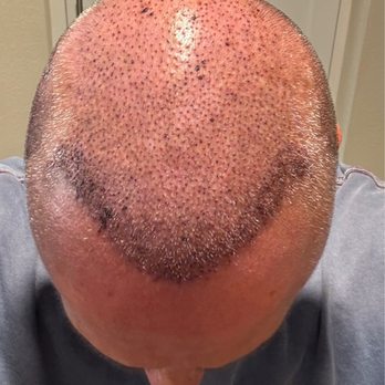 TJ Hair System - Hair Loss Centers Near Me - Tijuana, BCN TJ Hair System - Hair Loss Centers Near Me - Tijuana, BCN