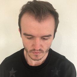 Photo after 5th PRP procedure September 27th, 2021 Photo after 5th PRP procedure September 27th, 2021