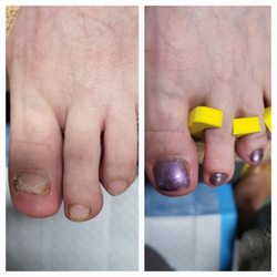 The Nail Industry Therapeutic Footcare - Toenail Reconstruction pedicure for damaged or injured nails