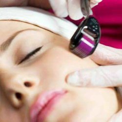Beauty by Sandra - Microneedling