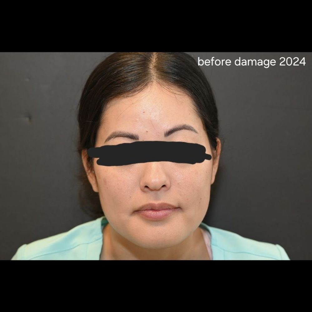 Oculofacial Plastic Surgery Hawaii - What my face looked like prior to this butcher shop - Cosmetic Surgeons Near Me - Honolulu, Hawaii Oculofacial Plastic Surgery Hawaii - What my face looked like prior to this butcher shop - Cosmetic Surgeons Near Me - Honolulu, Hawaii