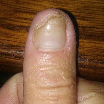 Kim's Pro Nails - WARNING!! I got nail fungus from this pace. This is a pic of the worst one after 1 month of treatment. - Nail Salons Near Me - Normal, Illinois