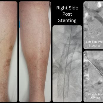 Advanced Surgical Care - Iliac Vein Stenting on an 87 year old patient. - Surgeons Near Me - Reno, Nevada Advanced Surgical Care - Iliac Vein Stenting on an 87 year old patient. - Surgeons Near Me - Reno, Nevada