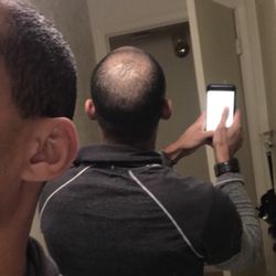 Bosley Hair Restoration & Transplant - 15 days post FUE