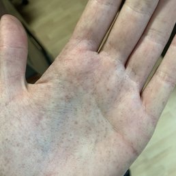Machine malfunctioned and my ENTIRE BODY WAS BLOTCHES AND POKA DOTS LIKE THIS