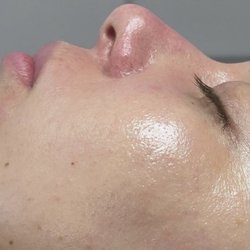 Soroor Beauty - Dermaplaning