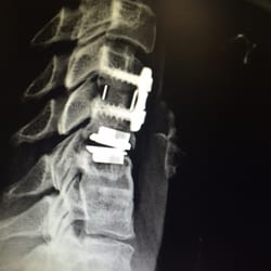 Luna Spine and Orthopaedic Surgery - Dr Luna did my fusion c4/5 above the c5/6 disk replacement on 4-1-16 and is healing well! Thank You Dr Luna! Joy Lynn Hemme