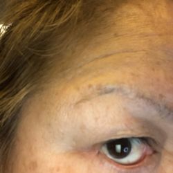 Lily Lee, MD - After 2nd surgery
