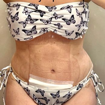 Emil Kohan, MD - 15 days post op - Plastic Surgeons Near Me - Beverly Hills, California Emil Kohan, MD - 15 days post op - Plastic Surgeons Near Me - Beverly Hills, California