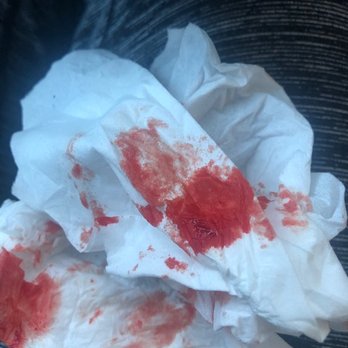 Metro Urgicare - This is a tissue that shows the bleeding that occurred from the way the nurse "swabbed" (assaulted) my inner nose. - Urgent Care Near Me - Brooklyn, New York