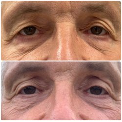 Beautiful You Aesthetics - Before and after 2 AgeJet Nitrogen Plasma Skin Tightening Treatments spaced 6 weeks apart! Amazing results and lift on his upper eyes!