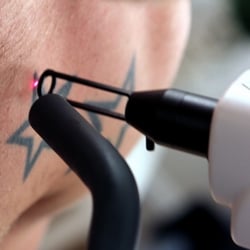 Tattoo Removals Clinic - Q-Laser Technology