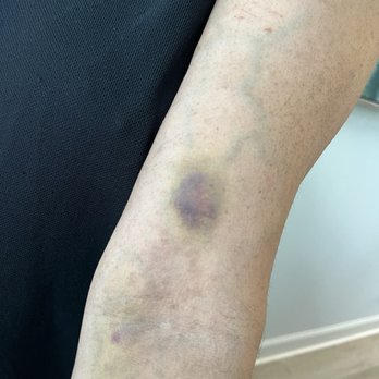 Quest Diagnostics - This pictures were taken after 7 days after the service was performed. Bruises still healing. - Laboratory Testing Near Me - St Augustine, Florida
