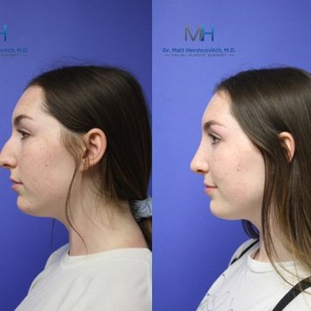 Matt Hershcovitch, MD - Rhinoplasty Before and After - Plastic Surgeons Near Me - Burbank, California Matt Hershcovitch, MD - Rhinoplasty Before and After - Plastic Surgeons Near Me - Burbank, California