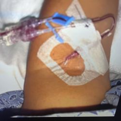 Lifekind Health - Rancho Mirage - June 19, 2025 4 blood transfusions