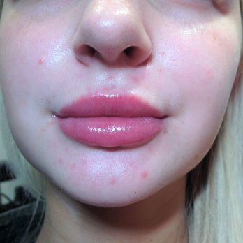 Venus Med Spa - Lip filler results - Medical Spas Near Me - Elmhurst, Illinois Venus Med Spa - Lip filler results - Medical Spas Near Me - Elmhurst, Illinois