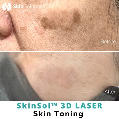SkinSol™ 3D Laser Skin Toning - SkinSol™ 3D Laser Skin Toning which includes a total of 3 sessions of laser treatments.
The 3 treatments consisted of:
✨VBeam
✨Hollywood Spectra
✨LaseMD Ultra