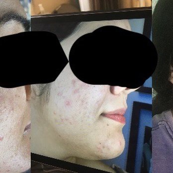 Seven:Thirty - Left and middle are before, right is during the process. - Skin Care Near Me - Berkeley, California