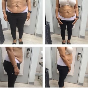 Renati Med Spa - Body Contouring. Burn off Fat and see instant results after just one treatment!!! - Medical Spas Near Me - Cypress, Texas