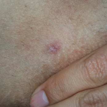 Body & Mind Spa - The scar I was left with from my Brazilian bikini wax at body & mind spa. - Massage Near Me - Aiea, Hawaii Body & Mind Spa - The scar I was left with from my Brazilian bikini wax at body & mind spa. - Massage Near Me - Aiea, Hawaii