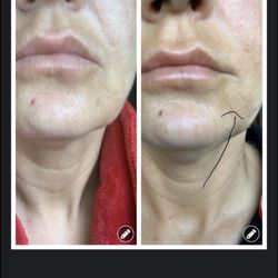 Pinnacle Dermatology - Smyrna - 1st pic taken May 26 before filler 2nd pic June 1- same place same lighting almost wk later