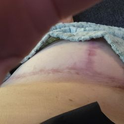 Alice B Woo, M.D - Left breast surgical scar.