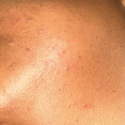 Kamana Beauty - Small cuts on face from threading.