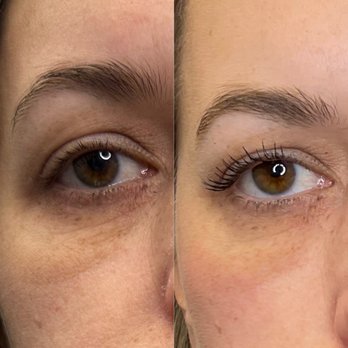 Melange Integrative Health - 2 weeks post under eye filler and 1st round of tear trough PDO smoothing threads - Medical Spas Near Me - Rochester, New Hampshire Melange Integrative Health - 2 weeks post under eye filler and 1st round of tear trough PDO smoothing threads - Medical Spas Near Me - Rochester, New Hampshire